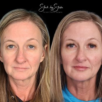 Stuck By Sticka - Full face rejuvenation with Botox and Juvederm Filler - Medical Spas Near Me - Keller, Texas Stuck By Sticka - Full face rejuvenation with Botox and Juvederm Filler - Medical Spas Near Me - Keller, Texas