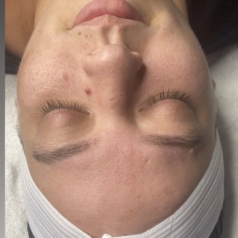 Beyouskinn - Before microdermabrasion! - Skin Care Near Me - Tampa, Florida Beyouskinn - Before microdermabrasion! - Skin Care Near Me - Tampa, Florida