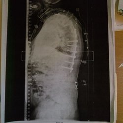 Roberto Rolando F MD Orthopaedic Surgery Spine - Here's the final x-ray. See how curved my back is from before the 1st and after the first?