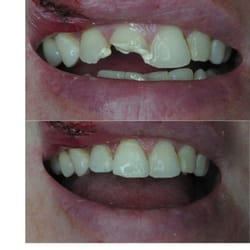 Antioch Lone Tree Dental - An emergency addressed with multi-disciplinary dentistry. Root canals and fillings.