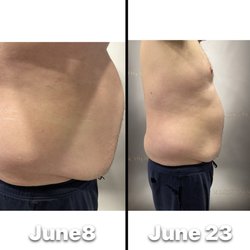 Sculpt Body Lounge - 20 LBS Lost in just 15 Days with Laser Lipo. Results will vary.