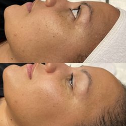 Skyn Haven Aesthetics - Before & After one facial treatment.