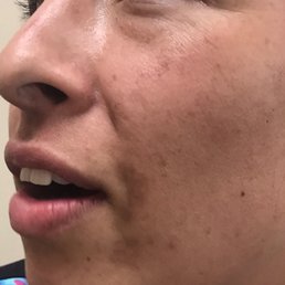 This is the result of lucianas chemical peel results. Do not go here!! Stay away!! This is the result of lucianas chemical peel results. Do not go here!! Stay away!!