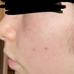 Clear Complexions - This this is after using their products. AMAZING.