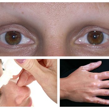 Permanent Make-up by Gloria Brennan - Medical Tattoos to treat Alopecia, Vitiligo and Dry Eye - Permanent Makeup Near Me - Owings Mills, Maryland Permanent Make-up by Gloria Brennan - Medical Tattoos to treat Alopecia, Vitiligo and Dry Eye - Permanent Makeup Near Me - Owings Mills, Maryland