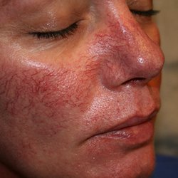 Bellevue Medispa - Before laser treatment