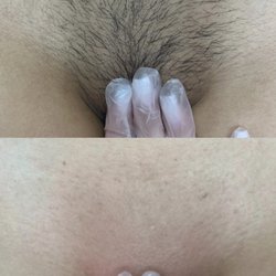 Brazilian wax