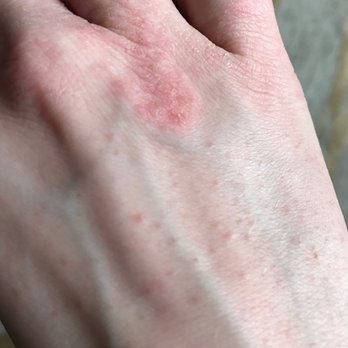 J'aime Nails - Rash from their hand cream one hour after lotion was applied. - Nail Salons Near Me - Astoria, New York J'aime Nails - Rash from their hand cream one hour after lotion was applied. - Nail Salons Near Me - Astoria, New York
