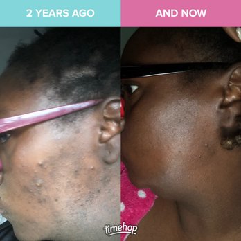 Nzuri by Sade - Before and After...products - Skin Care Near Me - Lanham, Maryland
