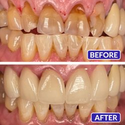 Smile Design Dentistry & Implant Center - Smile Design Dentistry & Implant Center - Multi-Crowns