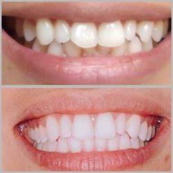 Catuira Family Dentistry - Before and After Six Month Smiles Clear Aligner Therapy