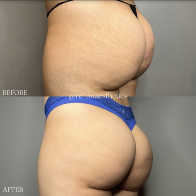 Non-Surgical Brazilian Butt Lift (BBL) - Looking for a way to enhance your curves without going under the knife? Look no further! We’ve got you covered with our non-surgical Brazilian Butt Lift (BBL) in Los Angeles, California. With our innovative techniques, you can achieve a fuller, more lifted posterior without the risks and downtime of surgery. Say goodbye to padded underwear and hello to a natural-looking, sculpted booty. Get ready to turn heads and feel confident in your own skin. It’s time to embrace your curves, the non-surgical way.
What Is a Non-Surgical Brazilian Butt Lift (BBL)
When it comes to alternative buttock enhancement options, the non-surgical BBL stands out as a popular choice. Unlike the traditional surgical procedure, which involves the transfer of fat from one area of your body to your buttocks, the non-surgical BBL relies on injectable fillers to enhance the shape and volume of your buttocks. One of the main advantages of the non-surgical BBL is that it is a minimally invasive procedure. This means that there are no incisions, stitches, or lengthy recovery times associated with surgery. Instead, the procedure can be performed in a medical office, and you can typically resume your normal activities right away. When comparing surgical and non-surgical buttock lifts, it’s important to consider your individual goals and preferences. While the surgical BBL may provide more dramatic results and longer-lasting effects, it also carries more risks and requires a more significant investment of time and money. Ultimately, the choice between surgical and non-surgical buttock lifts depends on your unique circumstances and desired outcome.
The Benefits of Non-Surgical BBL in Los Angeles
One of the main benefits of non-surgical BBL is that it does not require any incisions or anesthesia. The procedure involves using dermal fillers and body contouring to add volume and shape to the buttocks. This means that there is no scarring and less risk of complications compared to traditional surgical methods. Another advantage of non-surgical BBL is the minimal downtime associated with the procedure. Unlike surgical BBL, which may require weeks of recovery, non-surgical BBL allows you to resume your normal activities almost immediately. This makes it a convenient option for those with busy lifestyles. Furthermore, non-surgical BBL provides natural-looking results. Skilled practitioners can precisely inject fillers or transfer fat to create a more balanced and proportionate appearance. The results are long-lasting, and touch-up treatments can be performed as needed to maintain the desired look.
Why Choose Our Clinic for Non-Surgical BBL in California?
When considering non-surgical BBL in California, you should choose our clinic for its experienced professionals and state-of-the-art facilities. Our team of highly skilled and board-certified surgeons have extensive experience in performing non-surgical BBL procedures, ensuring that you receive the highest quality of care. One important factor to consider when choosing a non-surgical BBL clinic is the cost. At our clinic, we understand that cost is an important consideration for many patients. We offer competitive pricing options that are transparent and tailored to your specific needs. Our goal is to provide you with exceptional results at an affordable price. Another crucial aspect to consider is the recovery time for a non-surgical BBL. Unlike traditional surgical procedures, non-surgical BBL requires minimal downtime. Most patients can resume their daily activities within a few days after the procedure. However, it is important to note that individual recovery times may vary. In addition to our experienced professionals and cost-effective options, our clinic is equipped with state-of-the-art facilities. We prioritize your safety and comfort, ensuring that you receive the highest standard of care throughout your non-surgical BBL journey. When choosing a clinic for non-surgical BBL in California, consider our clinic for its experienced professionals, competitive pricing, minimal recovery time, and state-of-the-art facilities. We are dedicated to helping you achieve the desired results in the most efficient and effective way possible.