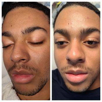 Glow Theory - Before on the left, After on the right - Skin Care Near Me - Union, New Jersey Glow Theory - Before on the left, After on the right - Skin Care Near Me - Union, New Jersey