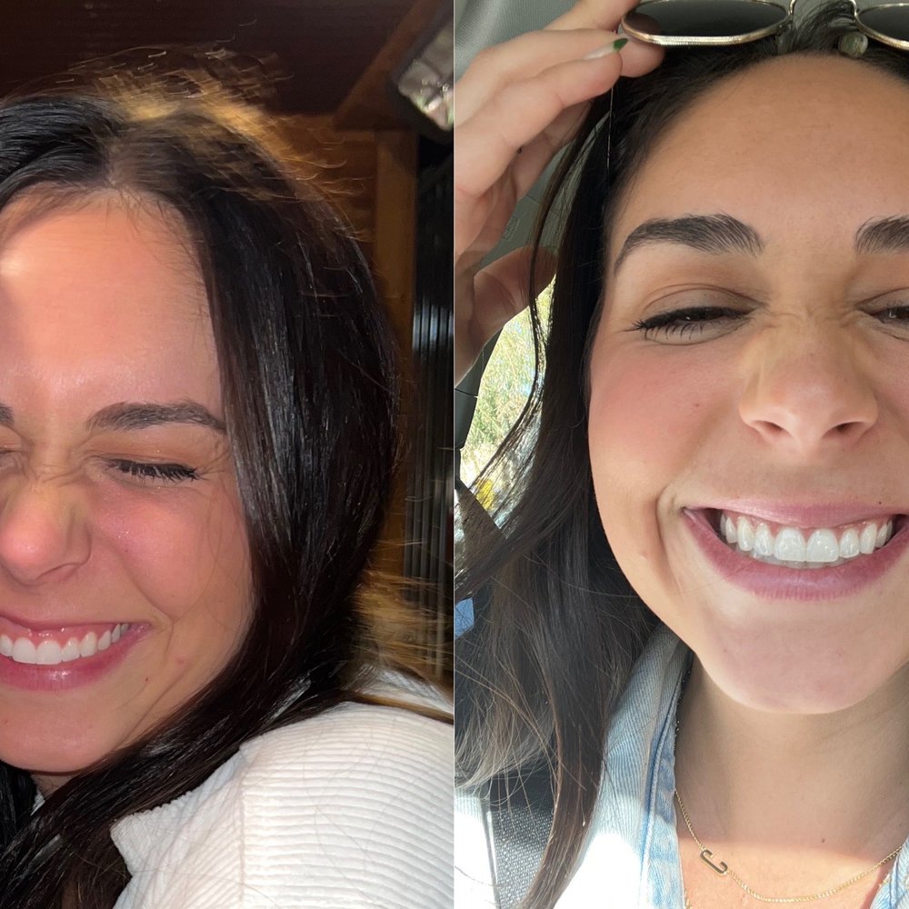 Forever Ageless - Lip flip 1 week difference!!!! - Medical Spas Near Me - Newport Beach, California Forever Ageless - Lip flip 1 week difference!!!! - Medical Spas Near Me - Newport Beach, California