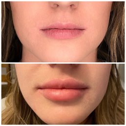 Two syringes juvederm lip injections