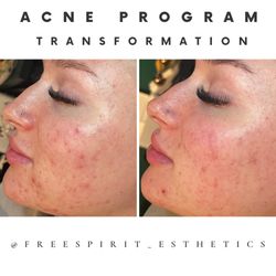 Scottsdale Skin and Head Spa - 6 Week Acne Program Transformation!