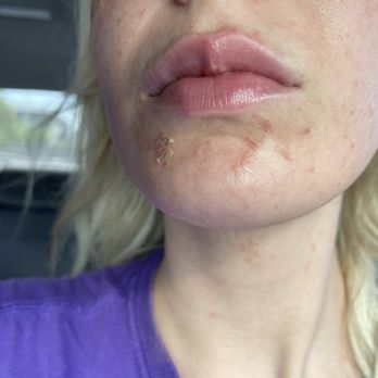 LaRose Nail Boutique - Wounds from waxing - Nail Salons Near Me - Paradise Valley, Arizona LaRose Nail Boutique - Wounds from waxing - Nail Salons Near Me - Paradise Valley, Arizona