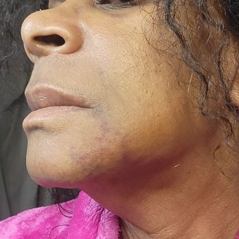 Ora Dentistry - Strange swelling and bruising. I expect lots, but this never subsided. - Cosmetic Dentists Near Me - Elk Grove, California Ora Dentistry - Strange swelling and bruising. I expect lots, but this never subsided. - Cosmetic Dentists Near Me - Elk Grove, California