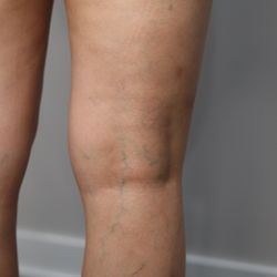 Loop Medical Center - Varicose veins may be unsightly but the more important reason for treatment is to protect your heart.  Call us to explain