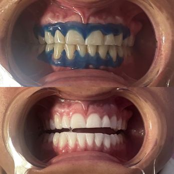 One Stop Shop Beauty Bar - This is me - Teeth Whitening Near Me - Fairfield, California One Stop Shop Beauty Bar - This is me - Teeth Whitening Near Me - Fairfield, California