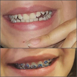 Before braces, with braces Before braces, with braces