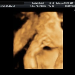 Eastside Maternal Fetal Medicine - View of my baby performed by Eastside Maternal Fetal Medicine. Equipment was top notch and doctor explained everything.