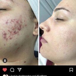 This is my before and after! Take a look at their IG profile for more! This is my before and after! Take a look at their IG profile for more!