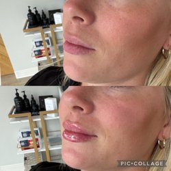 Curated Aesthetics & Wellness - Lip Filler before and after by Owner Taylor.