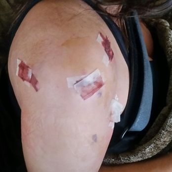 Demayo Frank MD - The day after my operation - Sports Medicine Near Me - Tracy, California Demayo Frank MD - The day after my operation - Sports Medicine Near Me - Tracy, California
