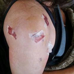 Demayo Frank MD - The day after my operation