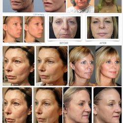Skinatomy Laser Clinic - Before and after