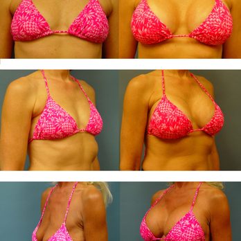Lorelle Kramer, MD - B&A Breast Augmentation on different ages - Cosmetic Surgeons Near Me - Wauwatosa, Wisconsin