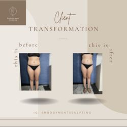Embodyment Sculpting - Laser Lipo (6 treatment package)