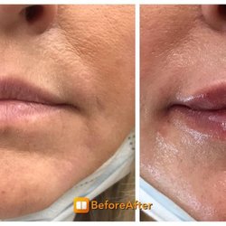 Montville MedSpa & Pain Center Fillers