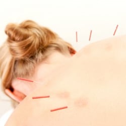 I Love Acu & Tuina Health Center - Acupuncture