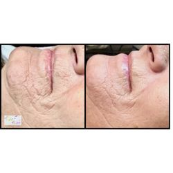 CA Skin & Body Clinic - CA Skin Rejuvenation Protocol. PRX-T33