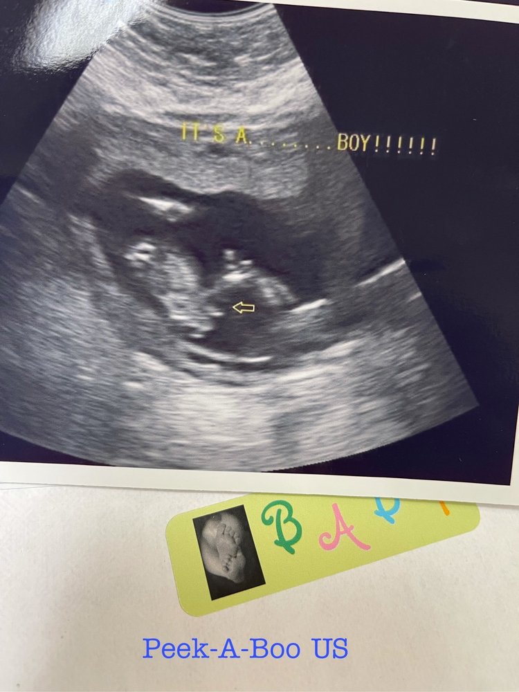 Peek A Boo 3D Ultrasound Santa Ana – NEBD