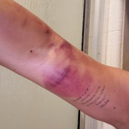 This is what they did to me here. Taking no responsibility of the injured they cause on my left arm when I told the worker she was HURTING m