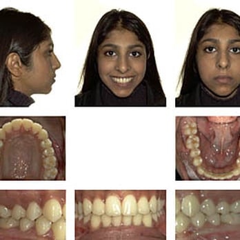 Guildford Orthodontic Centre - After - Orthodontists Near Me - Surrey, British Columbia