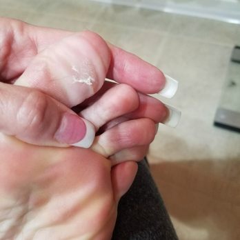 Sarasota Salon and Spa - Blisters 7 days later - Nail Salons Near Me - Sarasota, Florida Sarasota Salon and Spa - Blisters 7 days later - Nail Salons Near Me - Sarasota, Florida