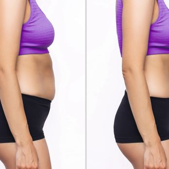 Dreambody Contouring - Before and after - Weight Loss Centers Near Me Dreambody Contouring - Before and after - Weight Loss Centers Near Me