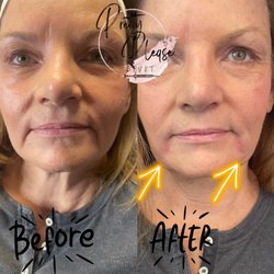 Pretty Please By KT - Marionette lines with dermal filler