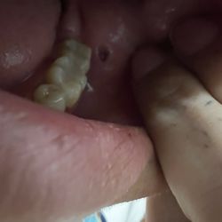 Golden Dental Group - HOLE IN MOUTH