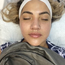 After Dermaplaning + Hydrafacial + britenol Facial After Dermaplaning + Hydrafacial + britenol Facial