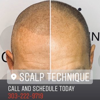 Scalp Technique - Hair Loss Centers Near Me - Broomfield, Colorado