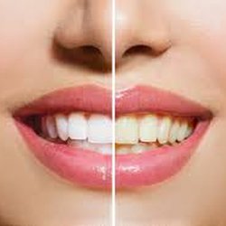 Smile Labs VIP - Before & After