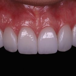 MiamiDentist4U by Javier Andrade DDS - Beautiful natural looking porcelain Veneers.