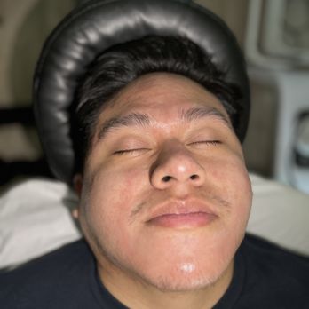 Llondon Aesthetics - (Post) Microneedling +Hyaluronic Acid - Waxing Near Me - Las Vegas, Nevada Llondon Aesthetics - (Post) Microneedling +Hyaluronic Acid - Waxing Near Me - Las Vegas, Nevada