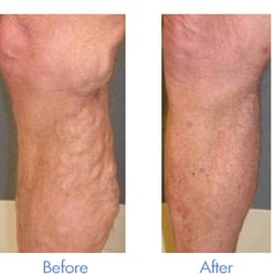 The Vein Center of Florida - Varicose vein treatment before & after