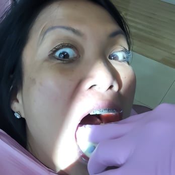 Brenn Orthodontics - Getting fitted for my retainer. - Orthodontists Near Me - Burbank, California